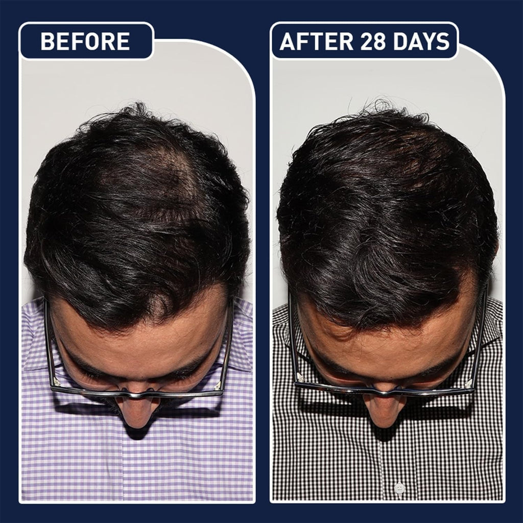 FEGPlus Minoxidil Serum