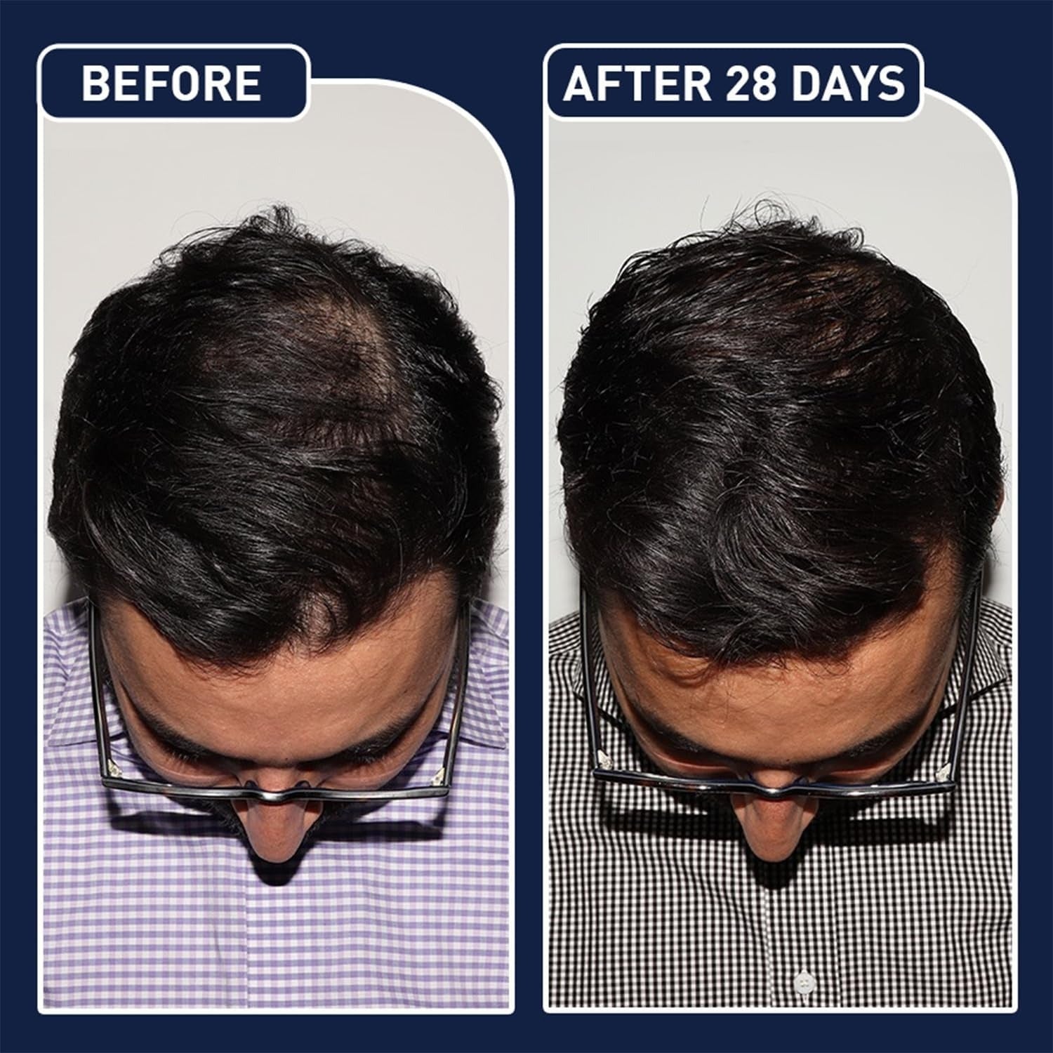 FEGPlus Minoxidil Serum